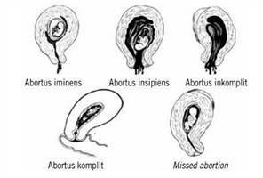 Gambar Abortus