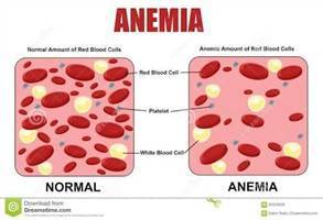Gambar Anemia