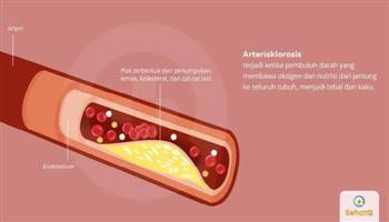Gambar Arteriosklerosis