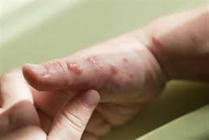 Gambar Dermatitis Kontak Akut