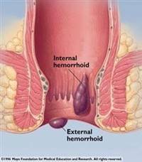 Gambar Hemoroid