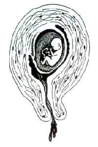 Gambar Abortus Insipiens
