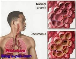 Gambar Alveolitis