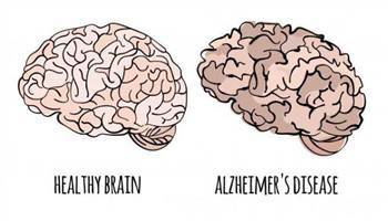 Gambar Alzheimer