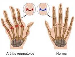 Gambar Artritis Reumatoid
