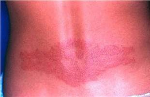 Gambar Dermatitis Kontak Alergik