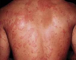 Gambar Dermatitis Medikamentosa