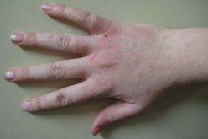 Gambar Dermatitis Subakut