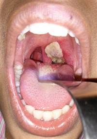 Gambar Difteri Tonsil