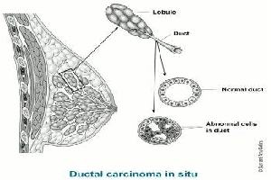 Gambar Ductal Carsinoma In Situ