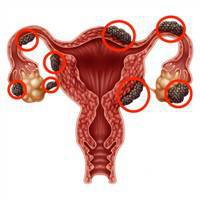 Gambar Endometriosis