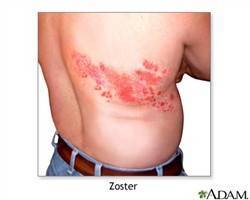 Gambar Herpes Zoster