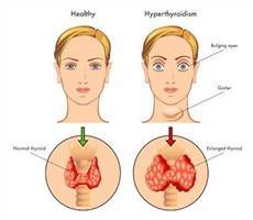 Gambar Hipertiroidisme