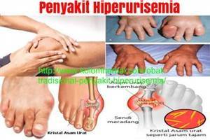 Gambar Hiperurisemia