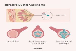 Gambar Invasive Ductal Carcinoma