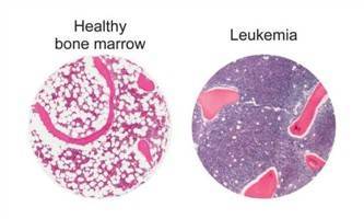 Gambar Leukemia
