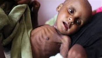 Gambar Malnutrisi