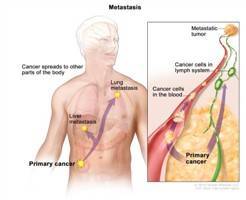 Gambar Metastasis