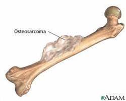 Gambar Osteosarkoma