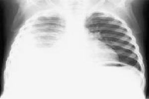 Gambar Pleuritis TB