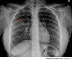 Gambar Pneumonia Mycoplasma