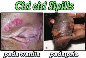 Gambar Sifilis