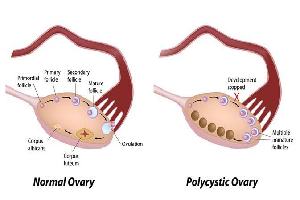 Gambar Sindrom Ovarium Polikistik
