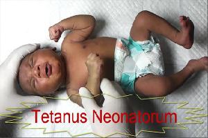 Gambar Tetanus Neonatorum