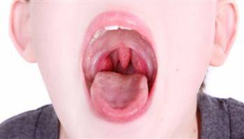 Gambar Tonsil