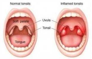 Gambar Tonsilitis Akut