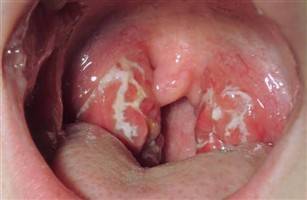 Gambar Tonsilitis Bakteri