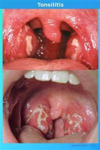 Gambar Tonsilitis Non Difteri