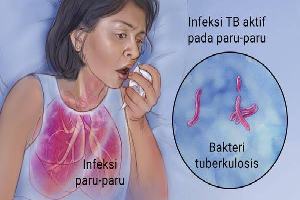 Gambar Tuberkulosis Aktif